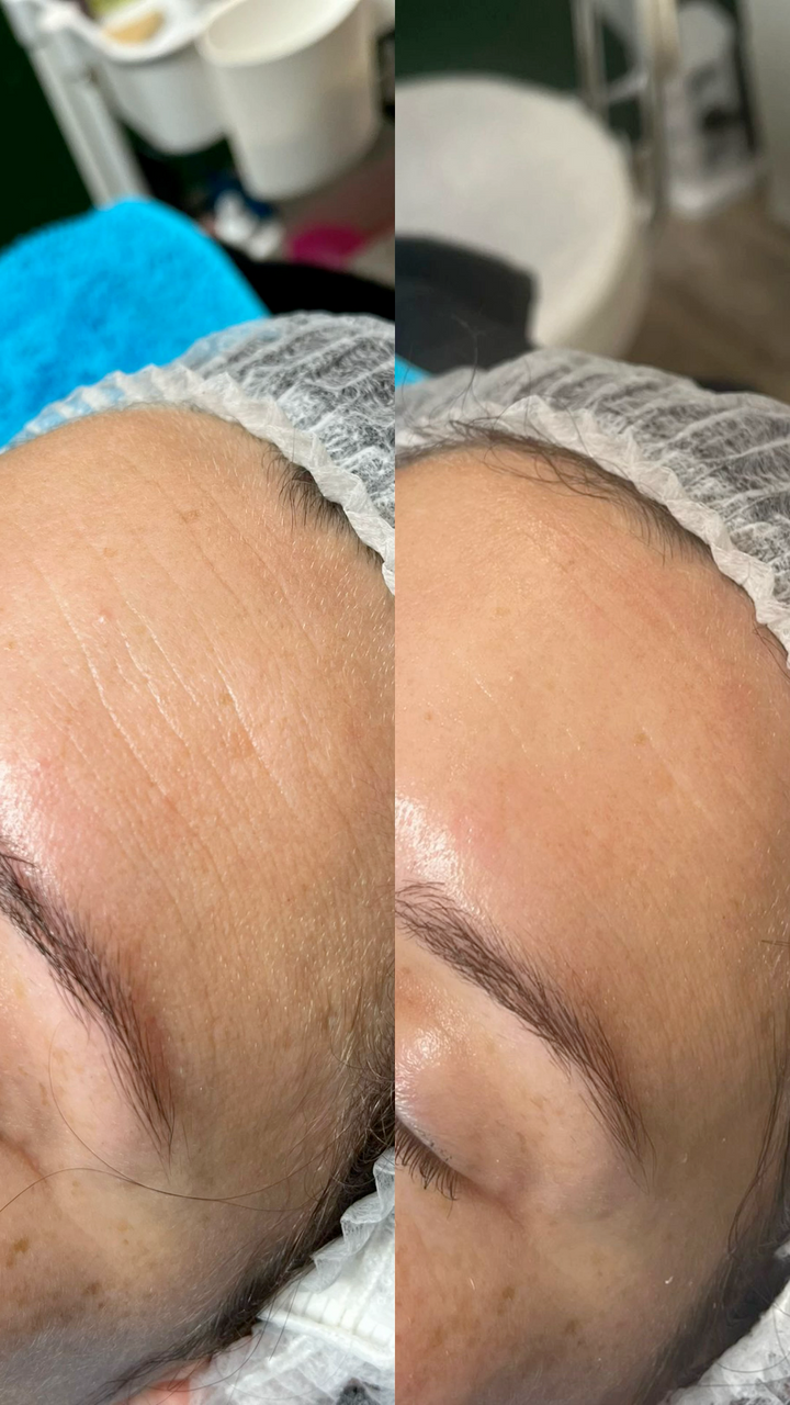 10 Fil tenseur de collagène de soie résorbable