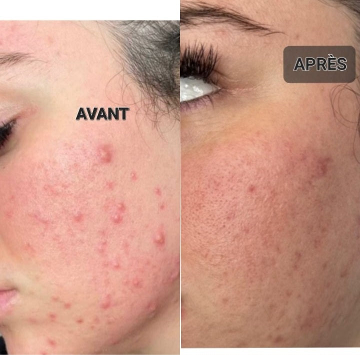 Peeling microneelding aux algues marine 100% naturel+ 1 MASQUE BIO ENZYMES OFFERT